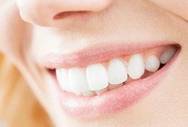 Faccette estetiche in una seduta